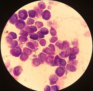 Mastocitoma